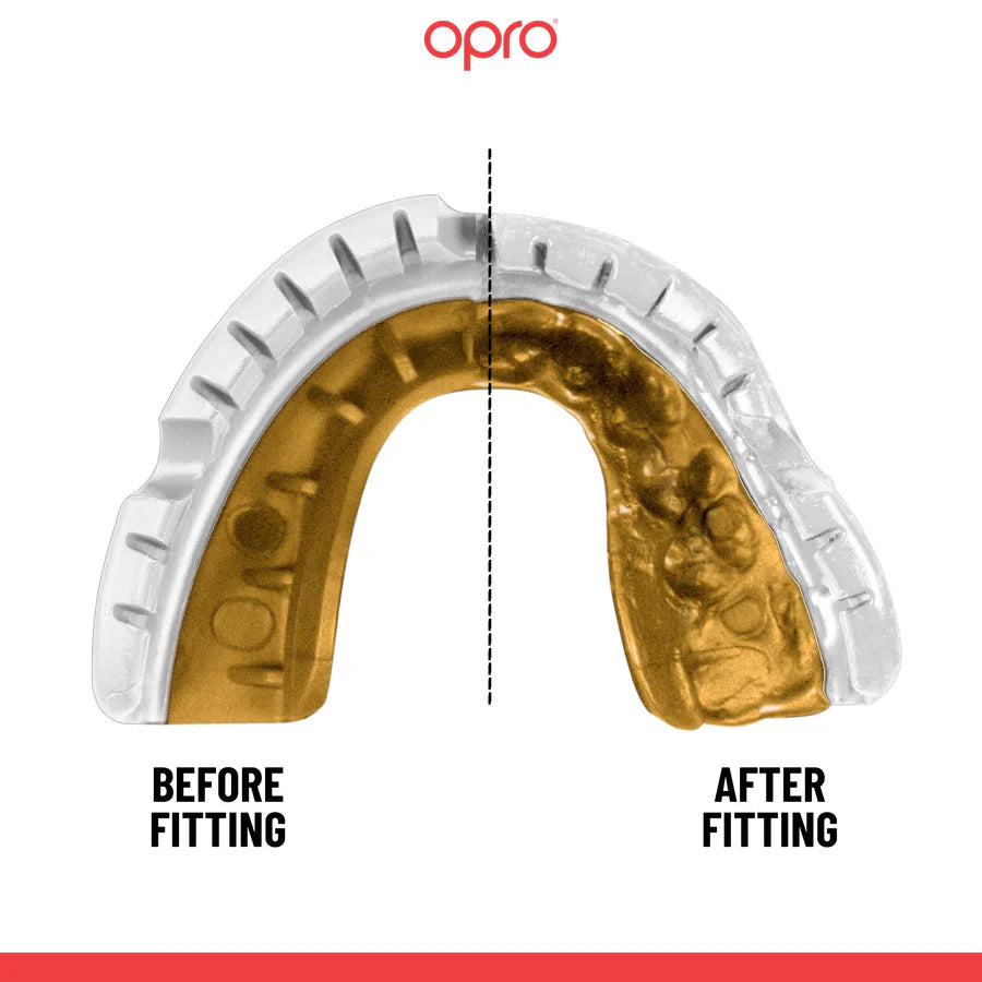 מגן שיניים לגשר OPRO Gold מקצועי